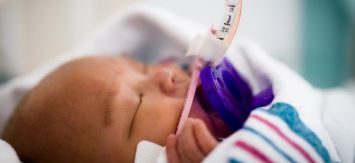 infant intubated